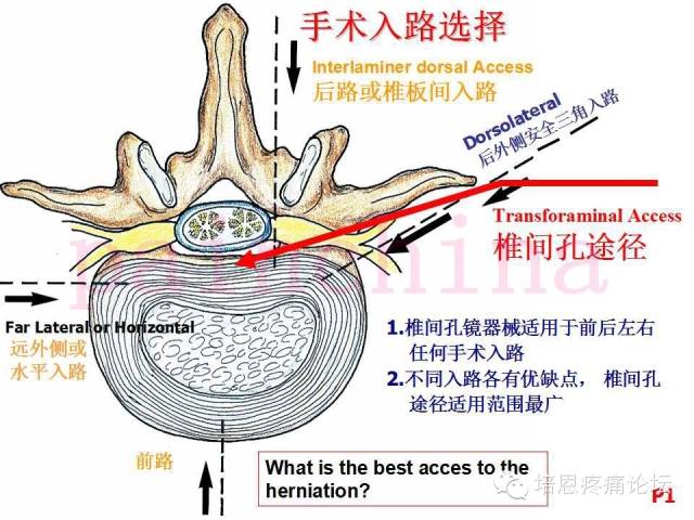 腰椎间盘突出症的治疗——椎间孔镜