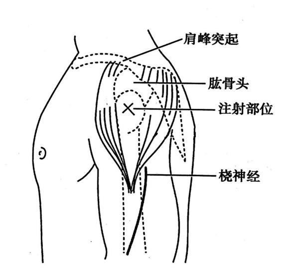 上臂三角肌简单定位法图片