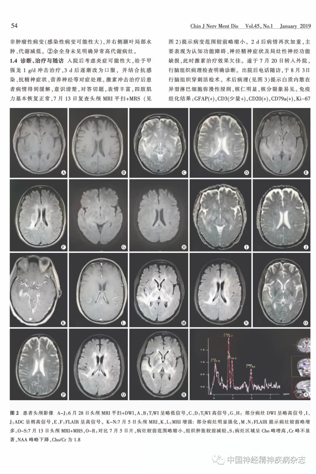 双侧额叶白质图片