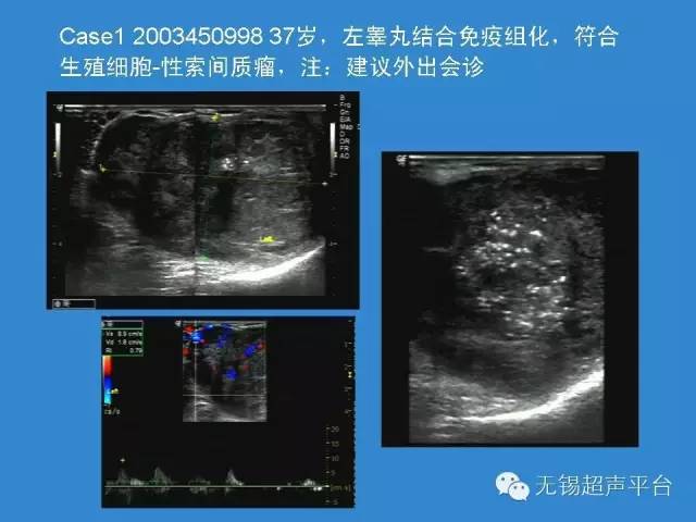 睾丸肿瘤超声表现图片图片