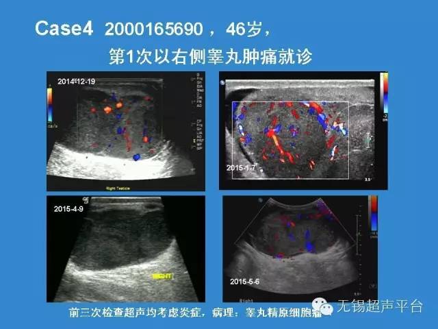 睪丸惡性腫瘤的超聲診斷