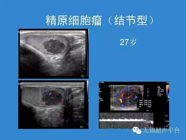 无性细胞瘤超声图像图片