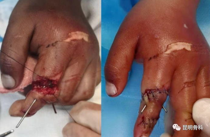 两名幼儿手指被绞断昆骨专家急诊保肢