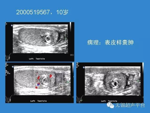 睪丸惡性腫瘤的超聲診斷