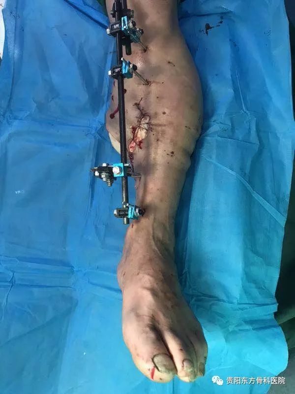 断肢缩短再植手术后图片经过一段时间的治疗,根据伤者的恢复情况,医院