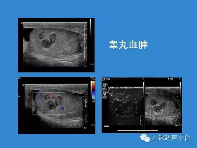 超聲醫學(第六版)淺表氣管超聲診斷吳階平泌尿外科學陰囊超聲診 