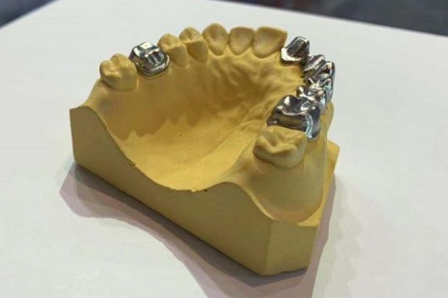 除此之外,牙齿铸造贵金属合金还需要通过检测密度,维氏密度,熔化范围