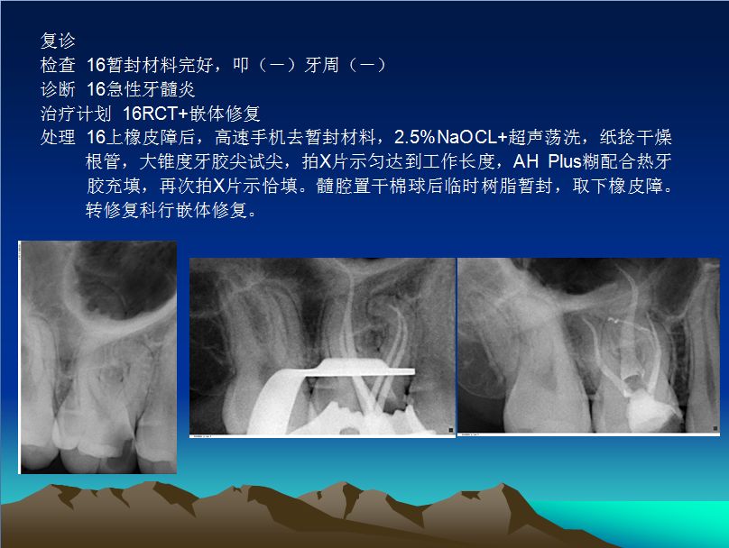 右上颌第一磨牙rct治疗一例赏析第三届萨尼蓝色梦想杯根管大赛