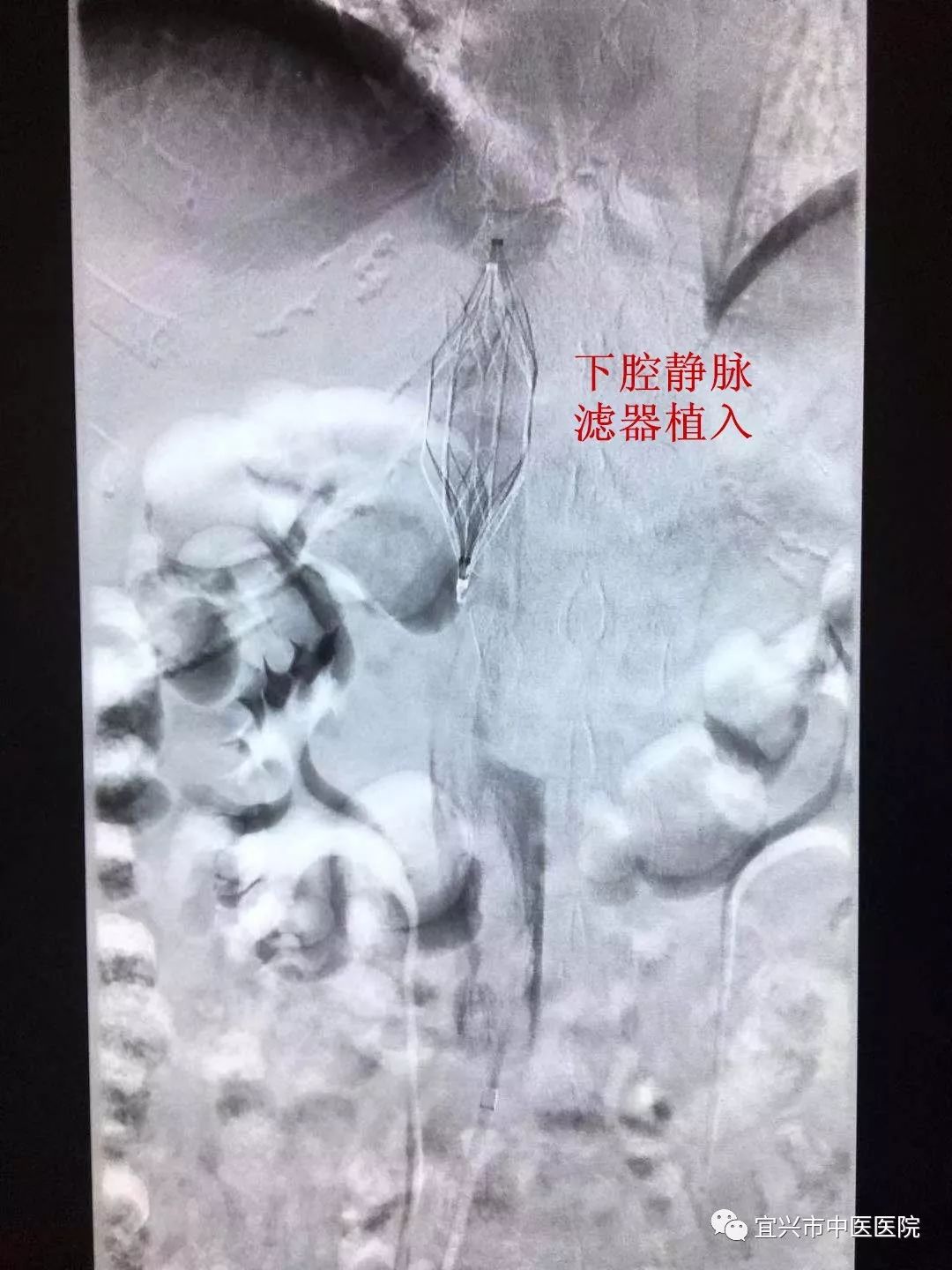 下腔静脉滤器超声图片