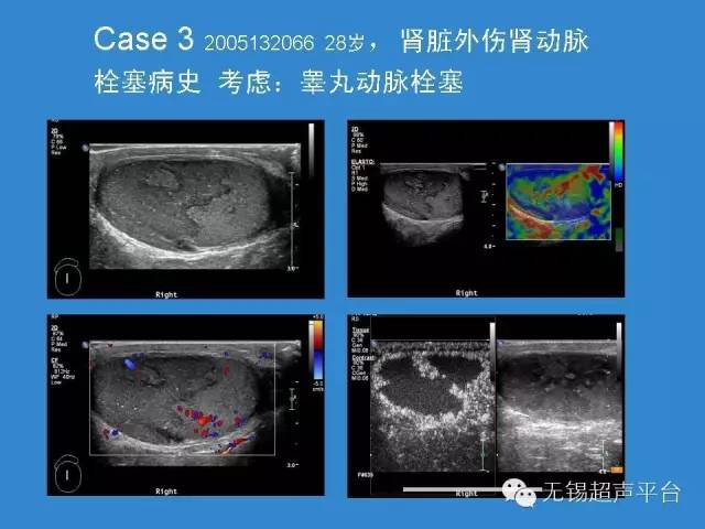 睪丸惡性腫瘤的超聲診斷