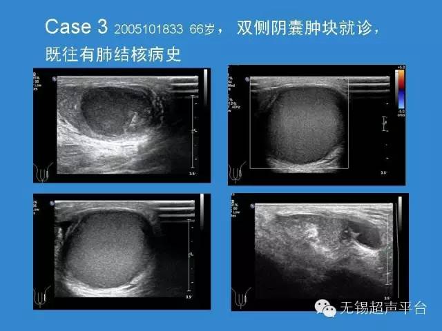 睾丸肿瘤超声表现图片图片