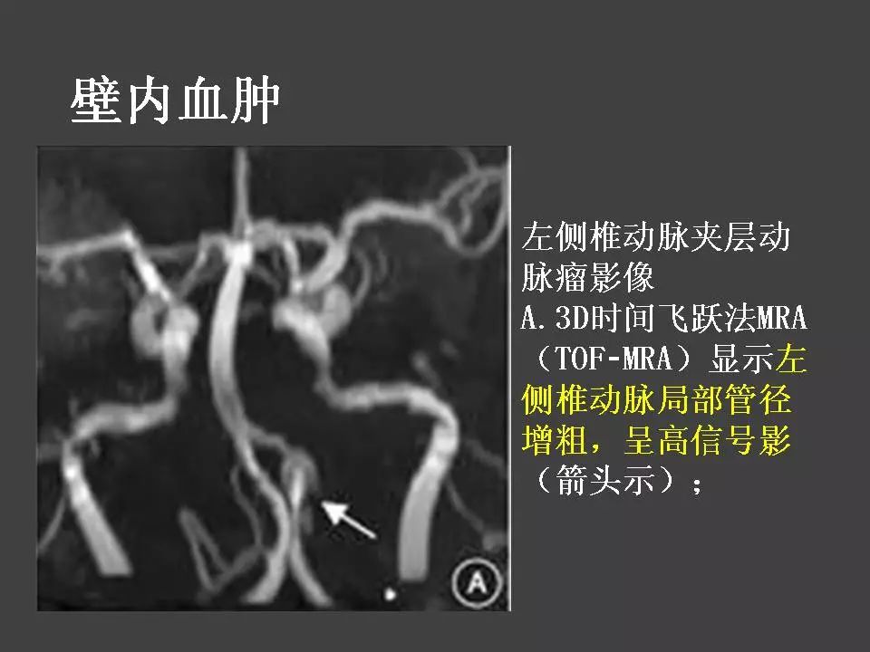 颈动脉夹层图片图片