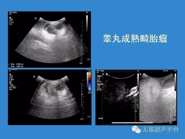 参考资料:超声医学(第六版)浅表气管超声诊断吴阶平泌尿外科学阴囊