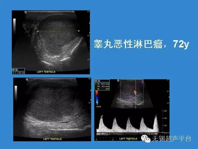 睾丸癌彩超图片图片