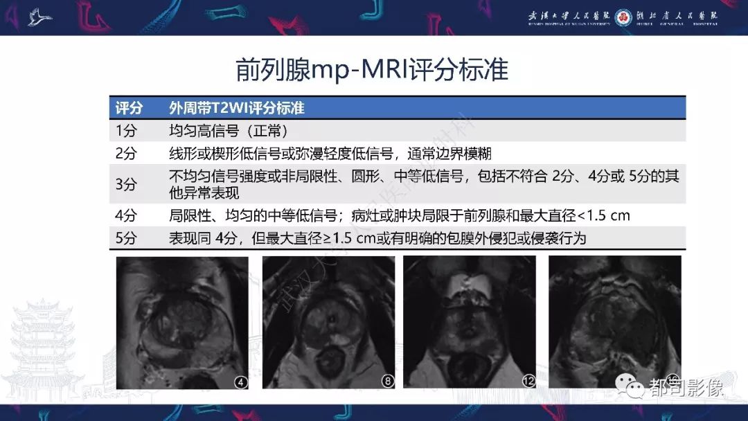 前列腺癌mri檢查和診斷共識