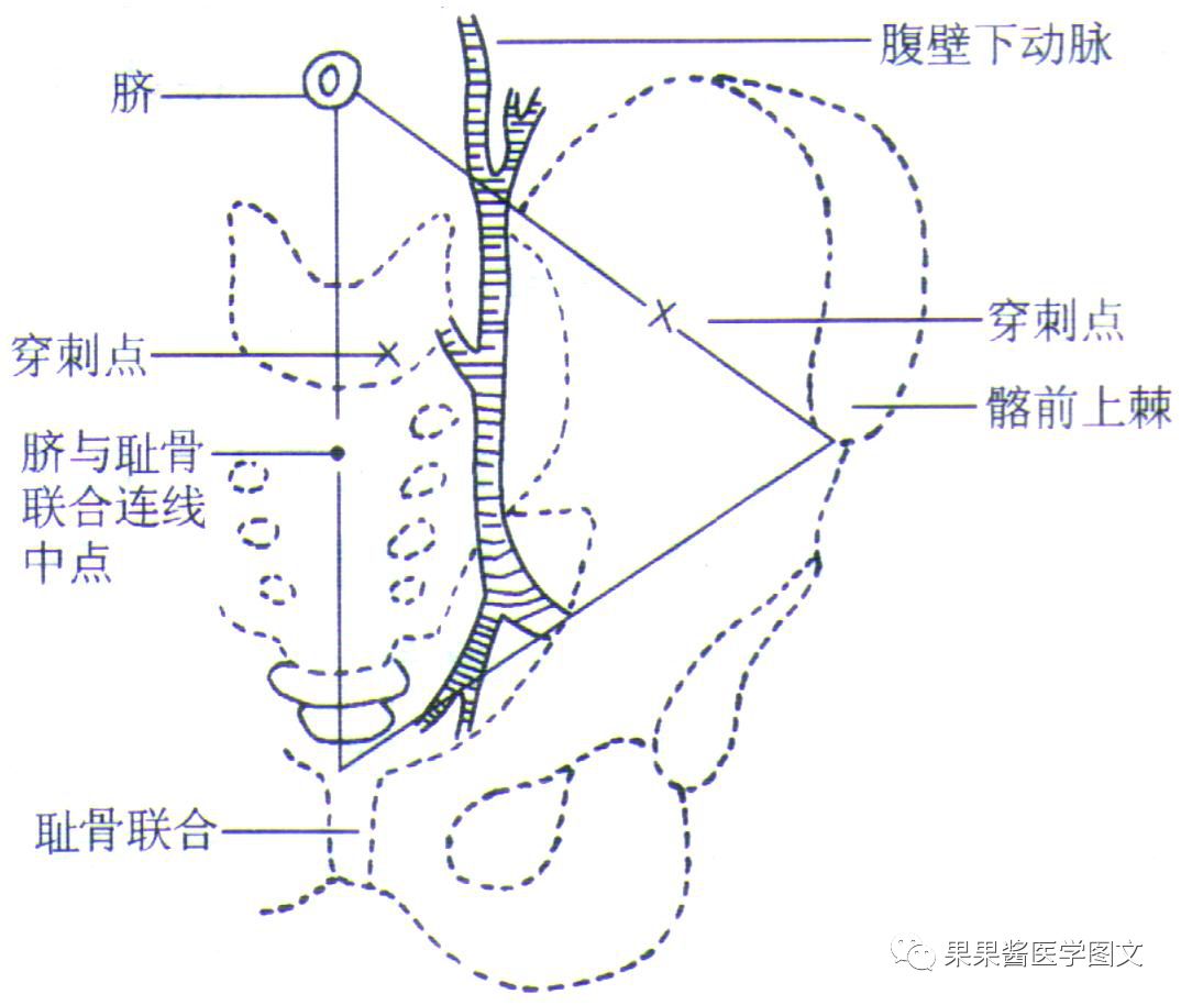 腹腔穿刺 图解图片