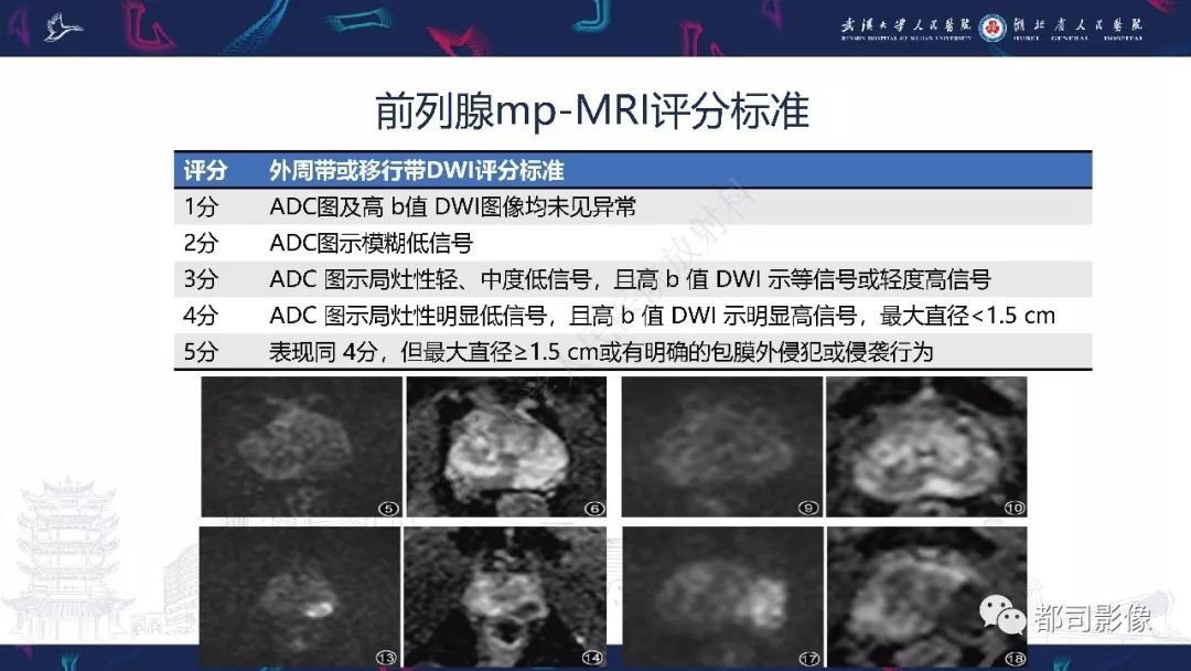 前列腺癌mri检查和诊断共识