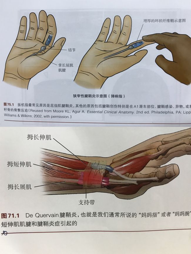 拇指腱鞘炎针刀示意图图片