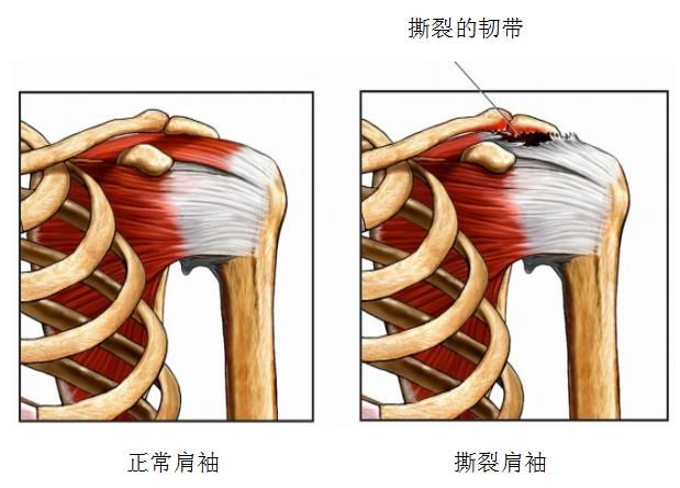 肩袖炎和肩周炎分别图图片