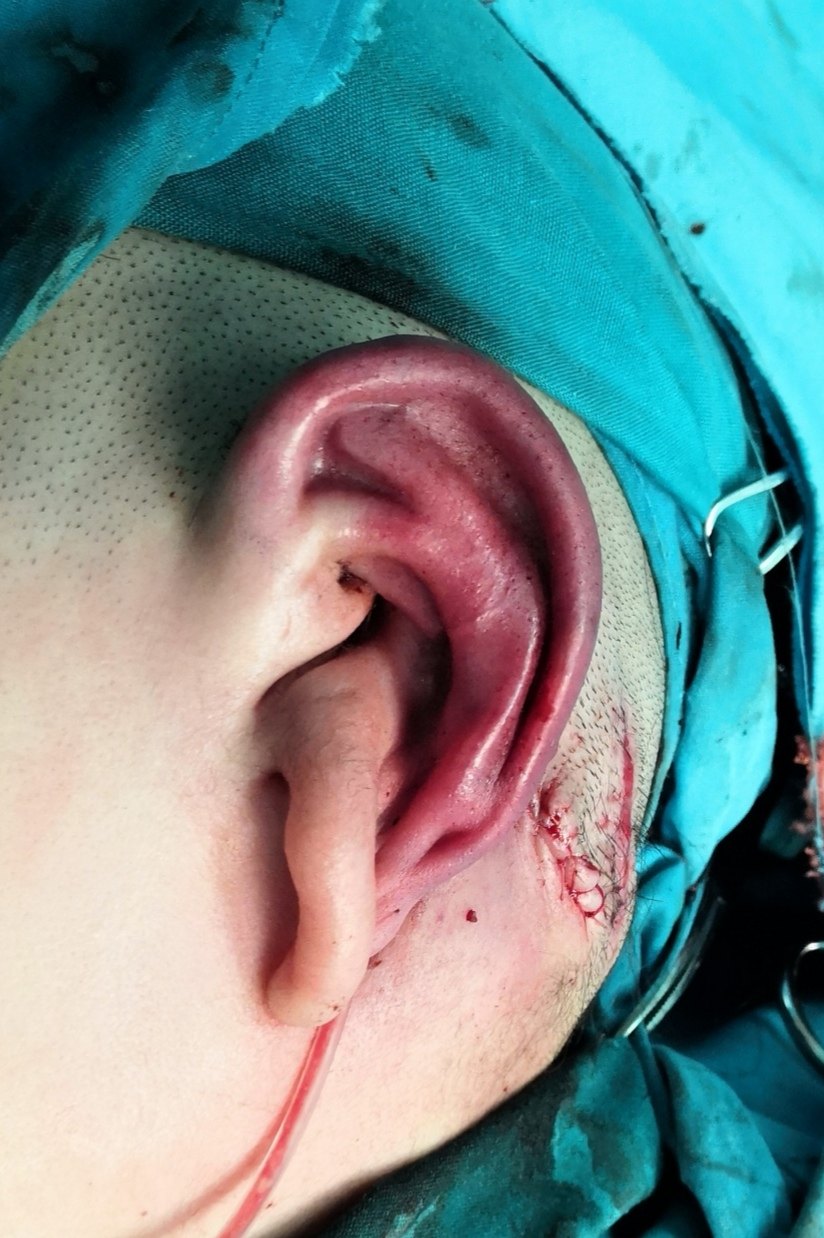 术中,取肋软骨雕刻耳支架,并植入扩张皮瓣下左侧小耳畸形,扩张器置入