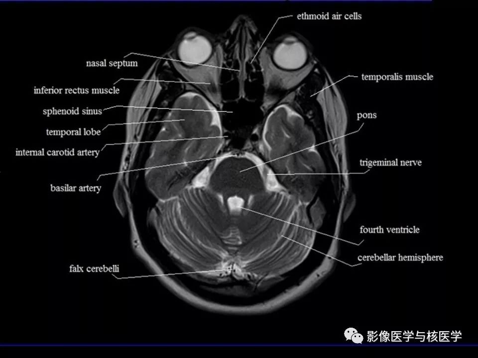 【影像解剖】头颅mr横断面解剖中英文对照