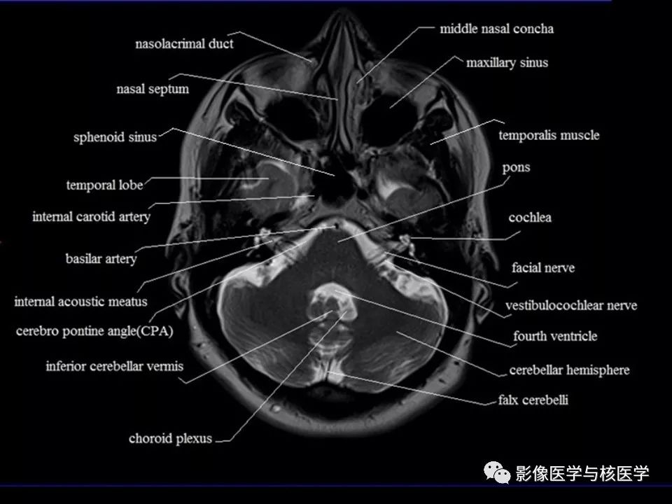 影像解剖頭顱mr橫斷面解剖中英文對照