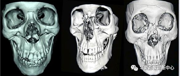 【影像基础】上颌骨骨折影像学分型