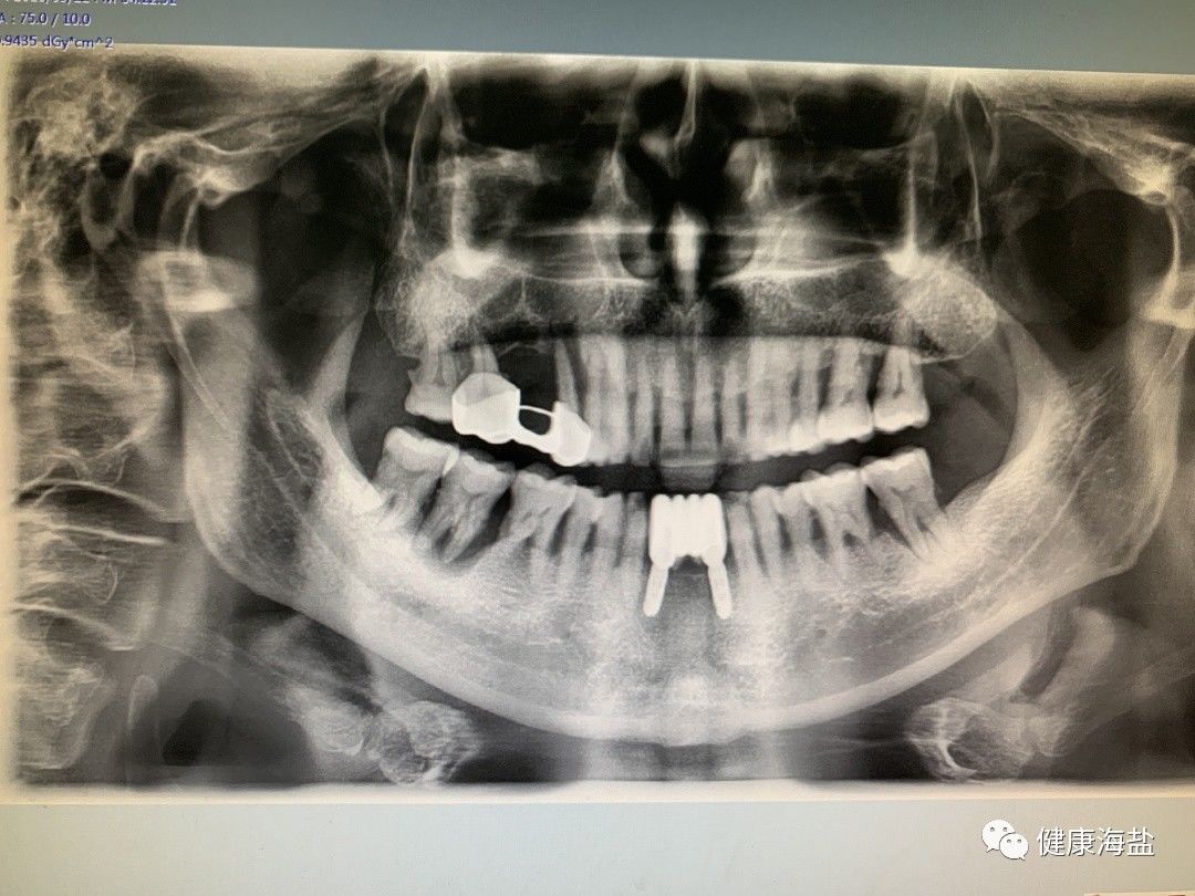 如:在牙槽骨內是否有埋伏牙,牙源性腫瘤和囊腫等.