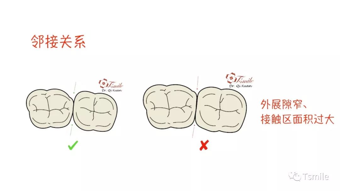 牙齿的外展隙图解图片