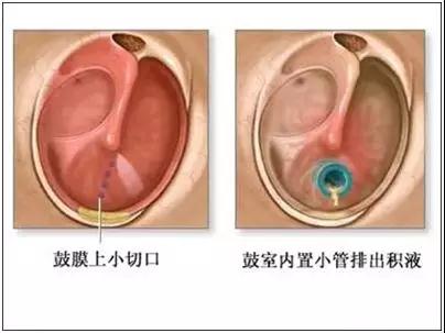 分泌性中耳炎手术方式