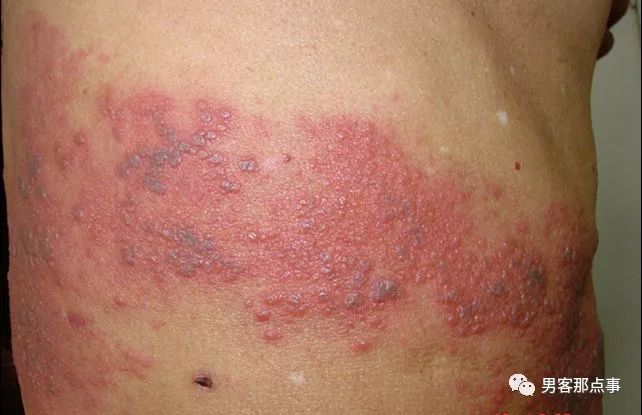 区别点四:皮损特征不同4生殖器疱疹发生在外阴的皮肤黏膜交界处;带状