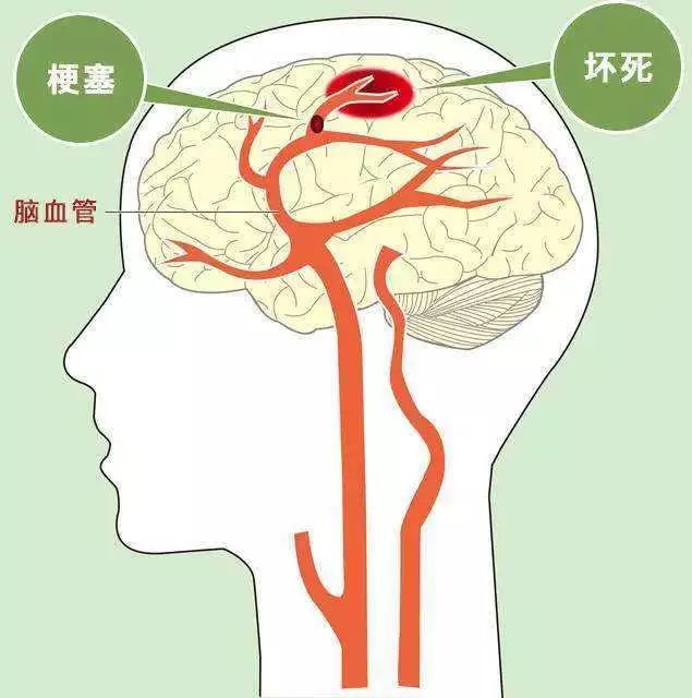 最常见的脑出血位置图图片