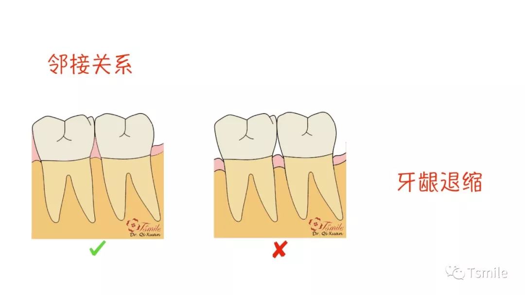 牙齿的外展隙图解图片