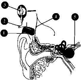 人工耳蝸式樣與原理