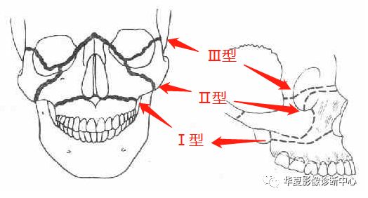 【影像基础】上颌骨骨折影像学分型_lefort