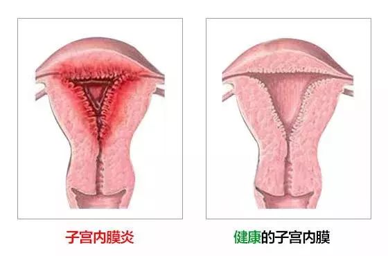 盆腔炎:盆腔炎常常波及卵巢,影响卵巢的正常功能,导致女性出现月经量