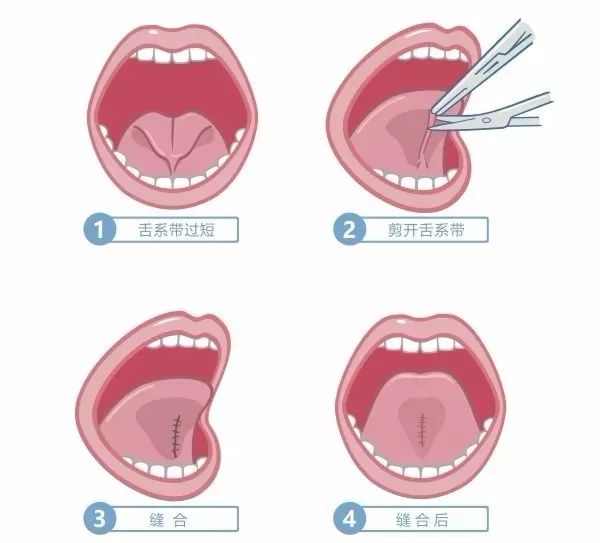 舌系带短是啥病?