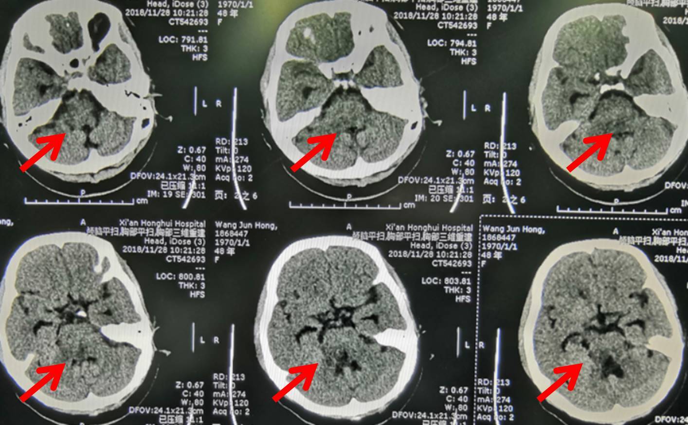 頭部ct片上白色顯示的血已經完全吸收
