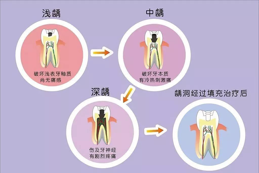 引起牙痛的6大禍首_牙髓炎