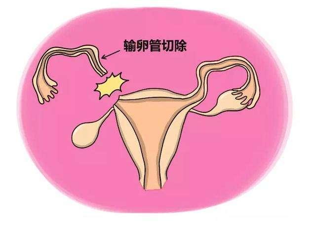 為什麼感覺宮外孕那麼常見,切了輸卵管女性怎麼辦?