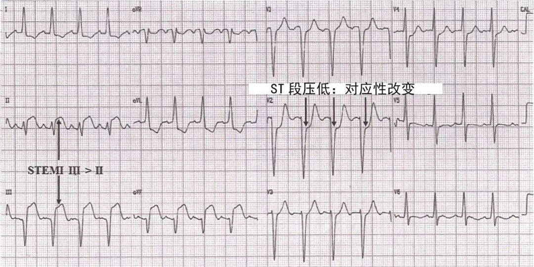 st抬高典型心电图图片