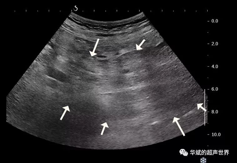 脂膜炎超声声像图图片