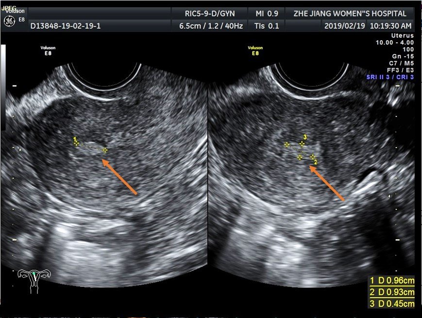 子宫b超图片解读图片