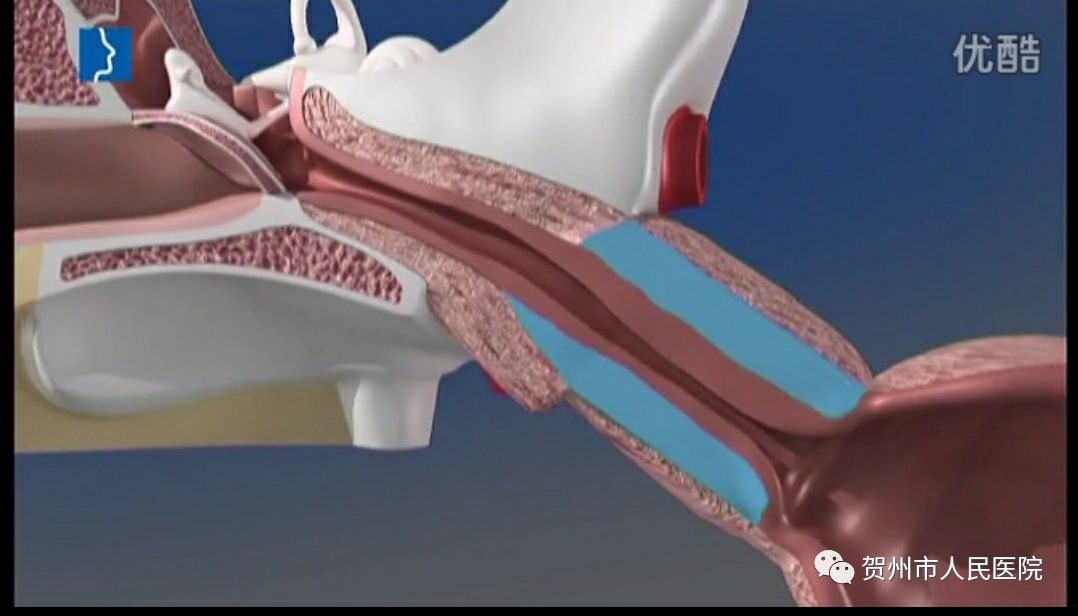 咽鼓管示意图图示:球囊扩张导管插入咽鼓管峡和软骨部进行扩张咽鼓管