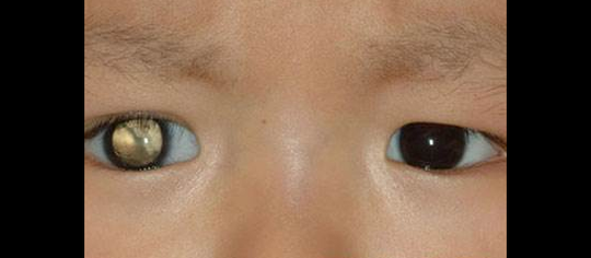 3岁以下儿童会得的猫眼病不能大意 疏忽治疗会致眼球摘除