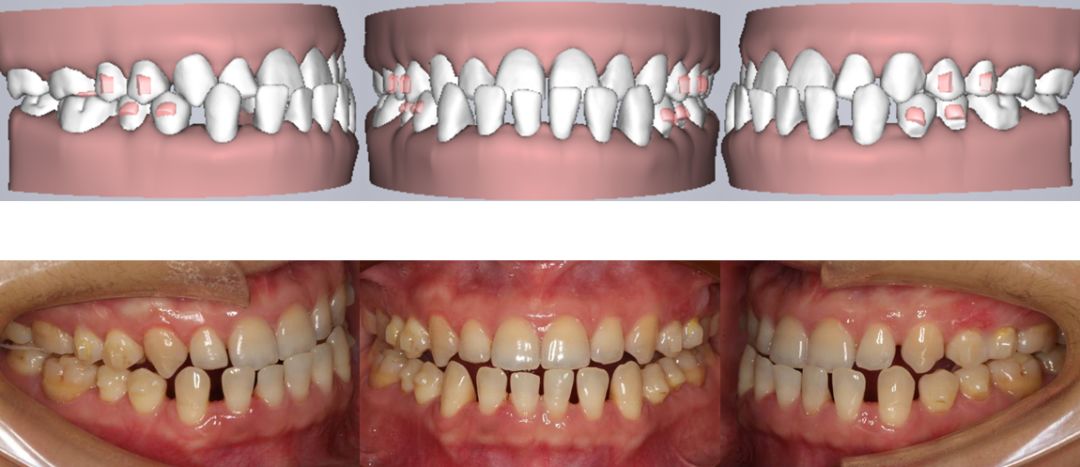 隱形矯治十強病例丨一例骨性Ⅲ類低角伴牙周病的隱形矯治