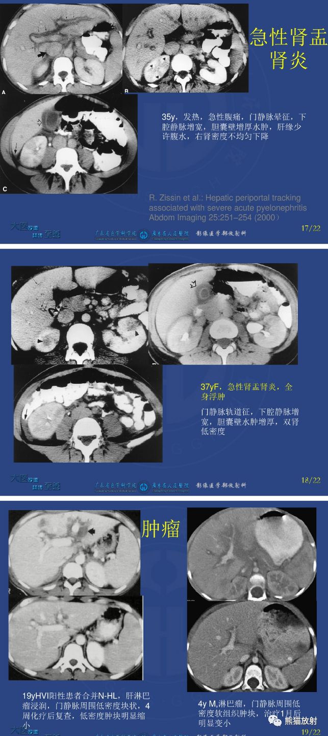 鑑別診斷丨肝門靜脈周透亮或水腫門靜脈周圍間隙增寬