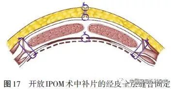 疝外科缝合技术与缝合材料选择中国专家共识2018版