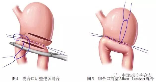 肠吻合器吻合术图解图片