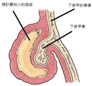 引发肥厚的鼻甲增加患者的呼吸困难,使得通气量不足,病人经常张口呼吸